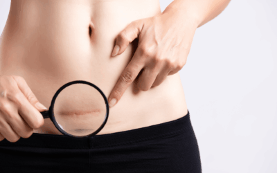 La cicatriz, la gran olvidada en el postparto