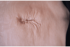 Diástasis Abdominal