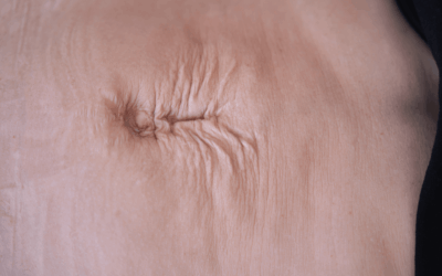 Diástasis Abdominal