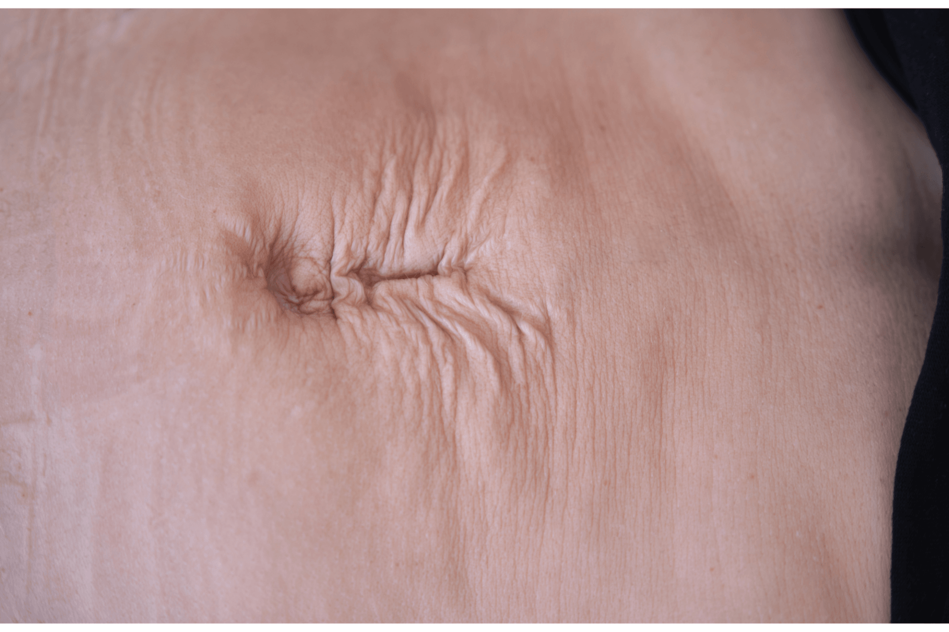 diastasis abdominal