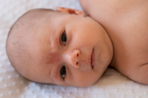 Tortícolis congénita en bebés