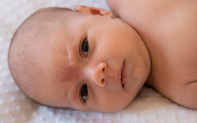 Tortícolis congénita en bebés