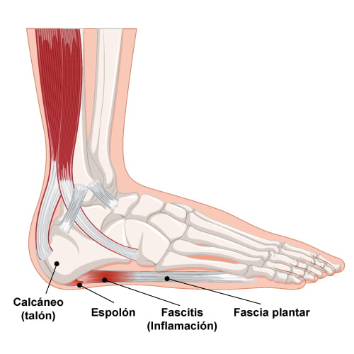 fascitis-plantar