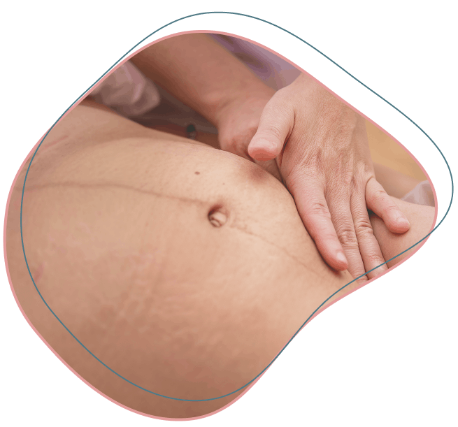 Estomago con cesárea y manos aplicando tratamiento