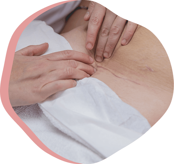 Manos tratando cicatriz de cesárea