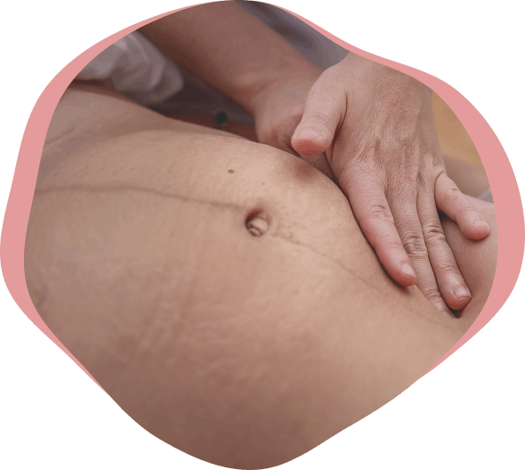 Tratamiento cicatriz cesárea en una paciente