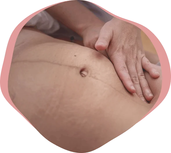 tratamiento cicatriz cesarea